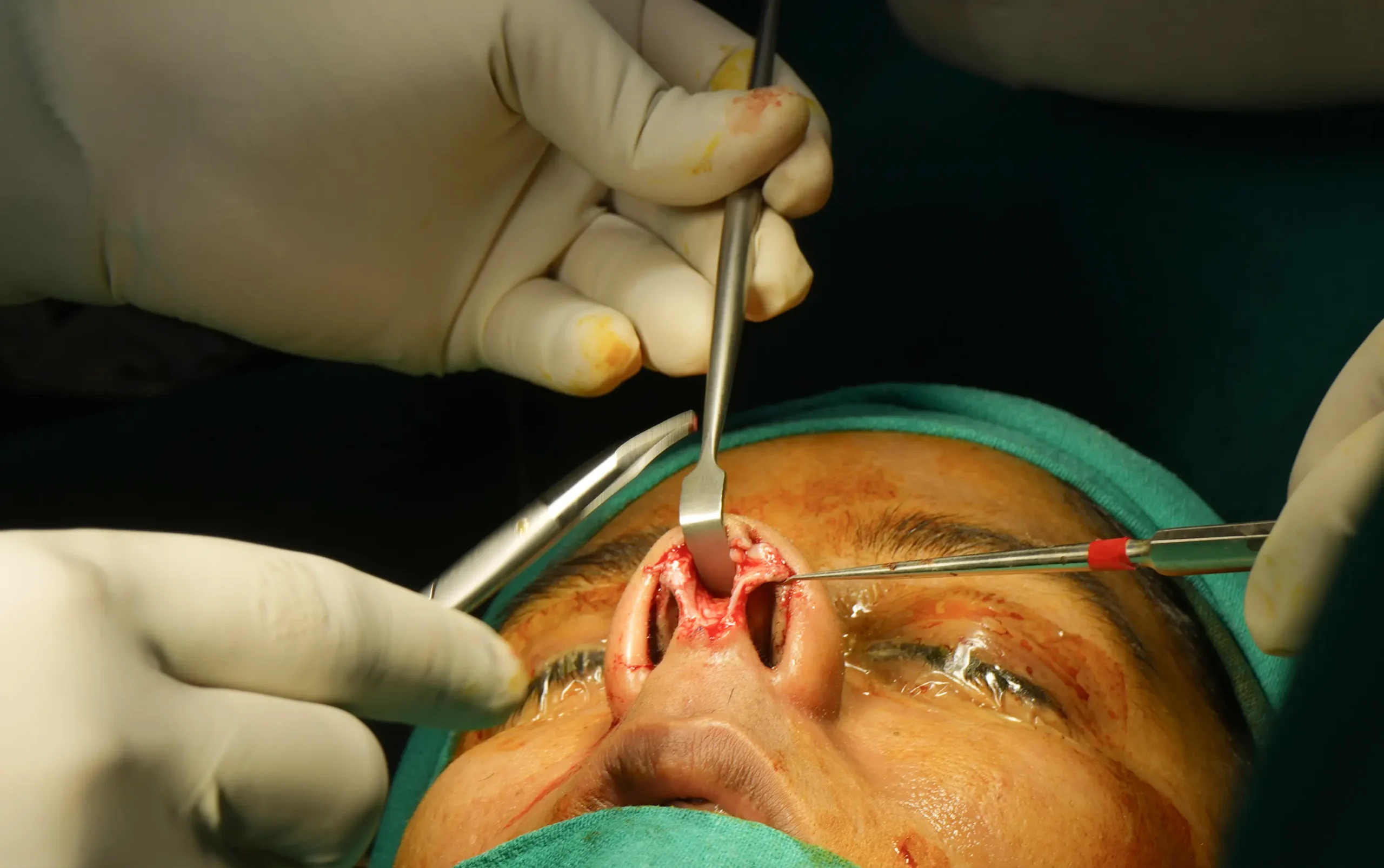 Rhinoplasty Intensive Course