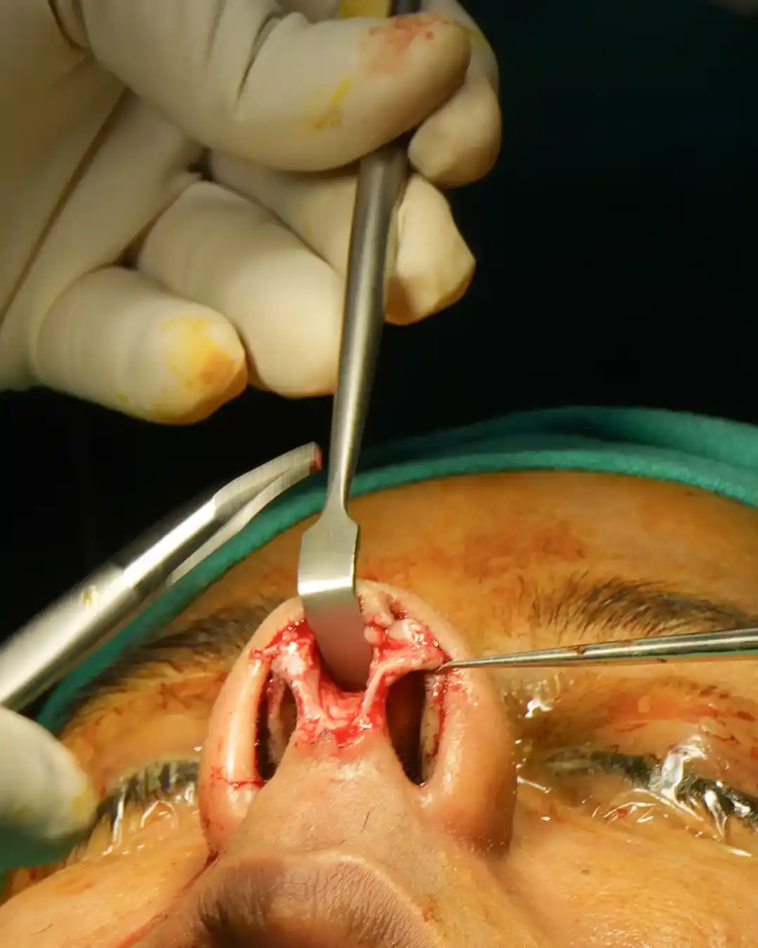 Rhinoplasty Intensive Course