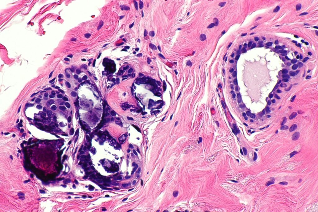 
More details
Benign calcification in breast, at high magnification