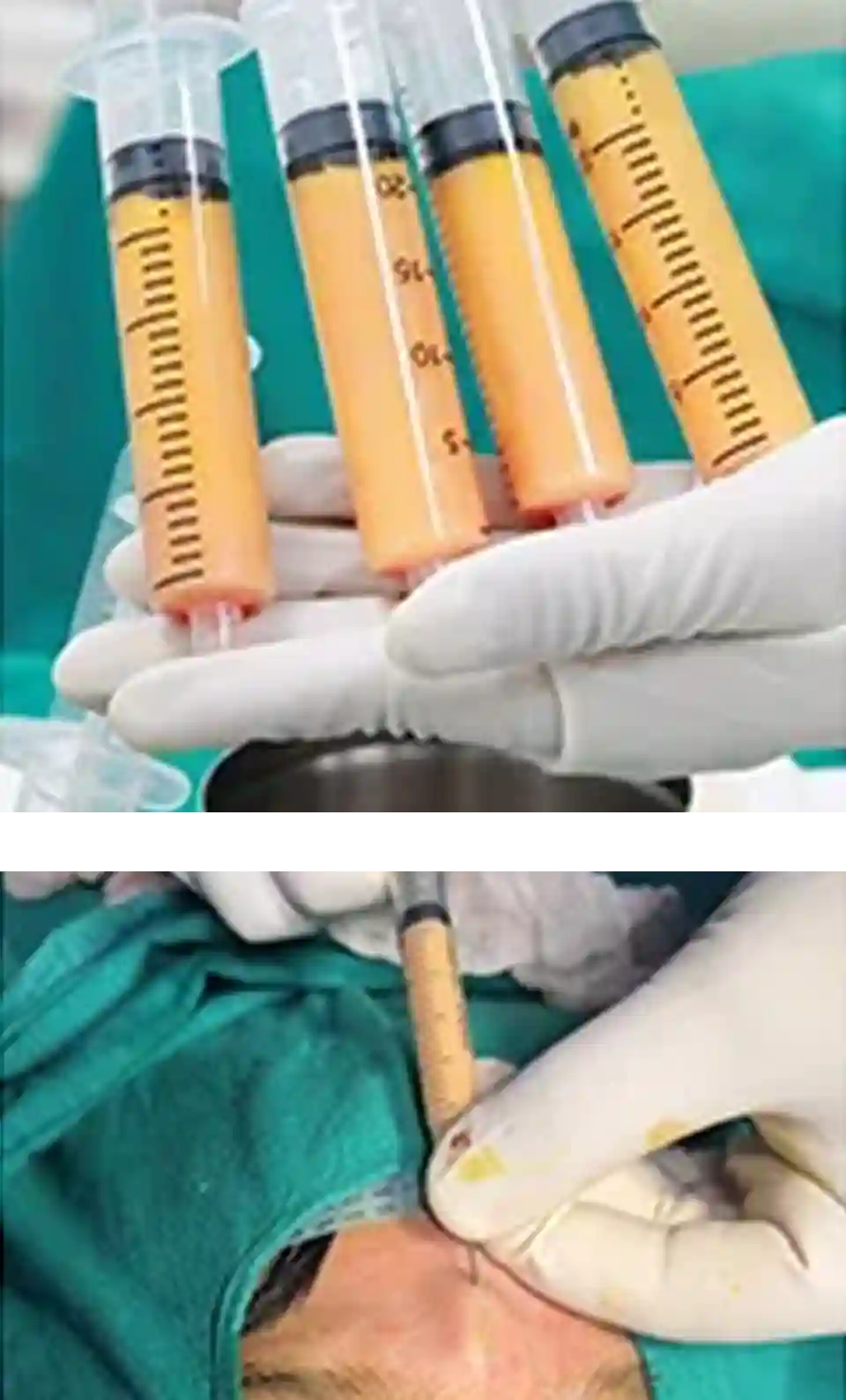 Facial Fat Grafting Course