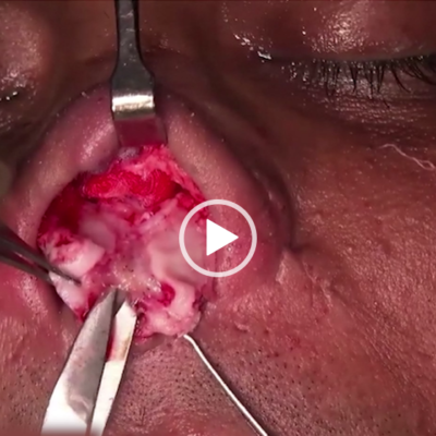 Rhinoplasty Course Online