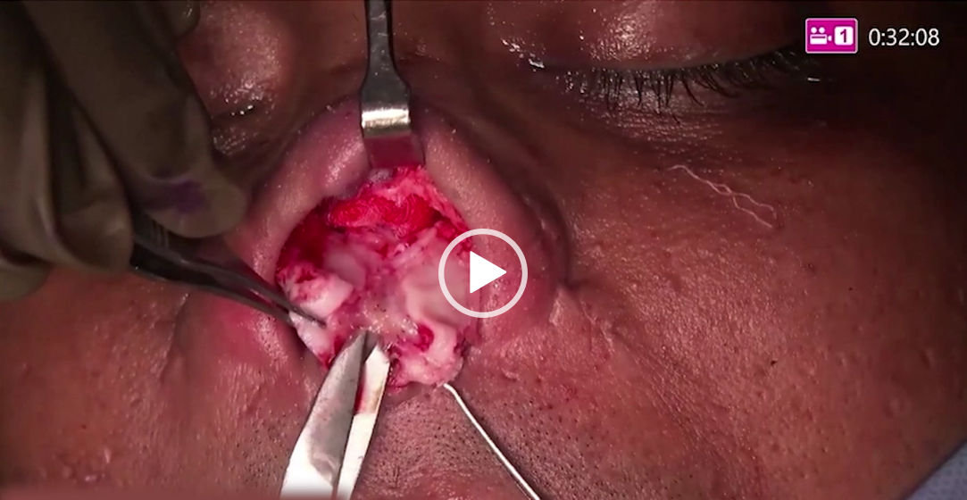 Rhinoplasty Course Online
